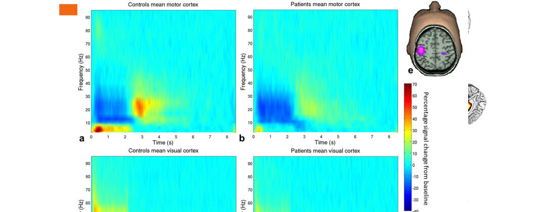 Evaluating Motor Disturbance in Schizophrenia