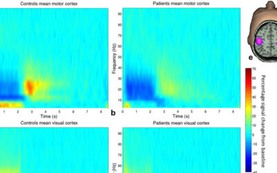 Evaluating Motor Disturbance in Schizophrenia